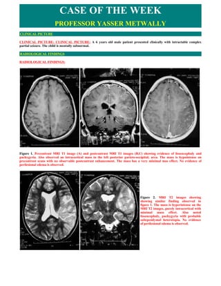 CASE OF THE WEEK
                       PROFESSOR YASSER METWALLY
CLINICAL PICTURE

CLINICAL PICTURE: CLINICAL PICTURE: A 6 years old male patient presented clinically with intractable complex
partial seizure. The child is mentally subnormal.

RADIOLOGICAL FINDINGS

RADIOLOGICAL FINDINGS:




Figure 1. Precontrast MRI T1 image (A) and postcontrast MRI T1 images (B,C) showing evidence of lissencephaly and
pachygyria. Also observed an intracortical mass in the left posterior parieto-occipital; area. The mass is hypointense on
precontrast scans with no observable postcontrast enhancement. The mass has a very minimal mas effect. No evidence of
perilesional edema is observed.




                                                                                Figure 2. MRI T2 images showing
                                                                                showing similar finding observed in
                                                                                figure 1. The mass is hyperintense on the
                                                                                MRI T2 images, purely intracortical with
                                                                                minimal mass effect. Also noted
                                                                                lissencephaly, pachygyria with probable
                                                                                subependymal heterotopia. No evidence
                                                                                of perilesional edema is observed.
 