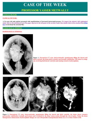 CASE OF THE WEEK
                               PROFESSOR YASSER METWALLY
CLINICAL PICTURE

CLINICAL PICTURE:

A 26 years old male patient presented with manifestations of increased intracranial pressue. (To inspect the patient's full radiological
study, click on the attachment icon (The paper clip icon in the left pane) of the acrobat reader then double click on the attached file) (Click
here to download the attached file)

RADIOLOGICAL FINDINGS

RADIOLOGICAL FINDINGS:




                                                    

                                                    

                                                    

                                                   Figure 1. Precontrast CT scan: Intraventricular ependymoma filling the lateral and
                                                   third ventricle, the lesion shows extensive perivascular calcification. The tumor is a huge
                                                   one, involving both lateral ventricles and causing extensive hydrocephalus.




Figure 2. Postcontrast CT scan: Intraventricular ependymoma filling the lateral and third ventricle, the lesion shows extensive
perivascular calcification (Actually perivenous) and is drained by the deep venous system through the vein of galen. Notice the dense
homogeneous enhancement. Hydrocephalic changes are seen with possible transependymal edema (A). (C is a bone window of B)
 