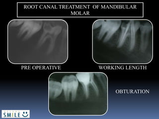 PRE OPERATIVE WORKING LENGTH
OBTURATION
ROOT CANAL TREATMENT OF MANDIBULAR
MOLAR
 