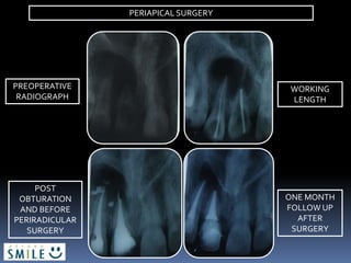 PREOPERATIVE
RADIOGRAPH
WORKING
LENGTH
POST
OBTURATION
AND BEFORE
PERIRADICULAR
SURGERY
ONE MONTH
FOLLOW UP
AFTER
SURGERY
PERIAPICAL SURGERY
 