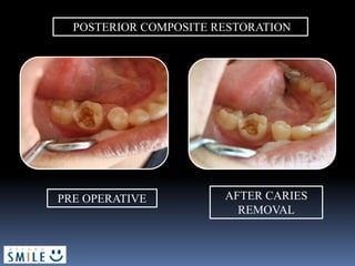 POSTERIOR COMPOSITE RESTORATION
PRE OPERATIVE AFTER CARIES
REMOVAL
 