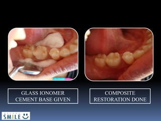 GLASS IONOMER
CEMENT BASE GIVEN
COMPOSITE
RESTORATION DONE
 