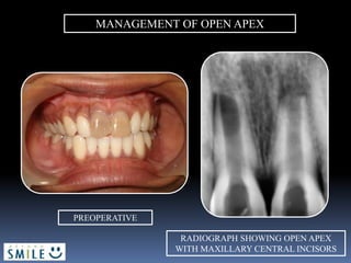 MANAGEMENT OF OPEN APEX
PREOPERATIVE
RADIOGRAPH SHOWING OPEN APEX
WITH MAXILLARY CENTRAL INCISORS
 