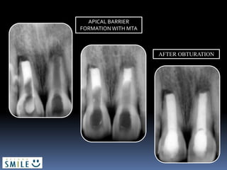 AFTER OBTURATION
APICAL BARRIER
FORMATIONWITH MTA
 