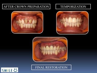 AFTER CROWN PREPARATION TEMPORIZATION
FINAL RESTORATION
 