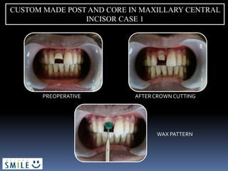 CUSTOM MADE POST AND CORE IN MAXILLARY CENTRAL
INCISOR CASE 1
PREOPERATIVE AFTER CROWN CUTTING
WAX PATTERN
 