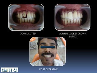 DOWEL LUTED ACRYLIC JACKET CROWN
LUTED
POST OPERATIVE
 