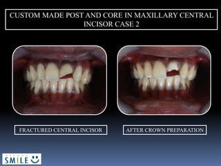 CUSTOM MADE POST AND CORE IN MAXILLARY CENTRAL
INCISOR CASE 2
FRACTURED CENTRAL INCISOR AFTER CROWN PREPARATION
 
