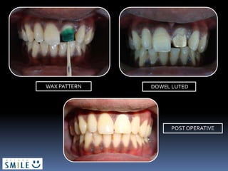 WAX PATTERN DOWEL LUTED
POST OPERATIVE
 