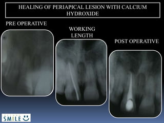 PRE OPERATIVE
POST OPERATIVE
WORKING
LENGTH
HEALING OF PERIAPICAL LESION WITH CALCIUM
HYDROXIDE
 