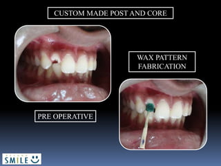 CUSTOM MADE POST AND CORE
PRE OPERATIVE
WAX PATTERN
FABRICATION
 