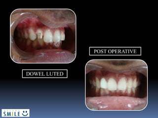 DOWEL LUTED
POST OPERATIVE
 
