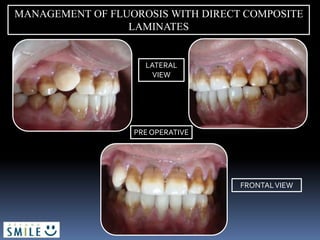MANAGEMENT OF FLUOROSIS WITH DIRECT COMPOSITE
LAMINATES
PRE OPERATIVE
LATERAL
VIEW
FRONTALVIEW
 