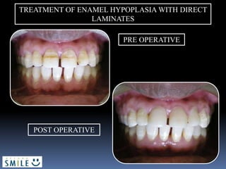 TREATMENT OF ENAMEL HYPOPLASIA WITH DIRECT
LAMINATES
PRE OPERATIVE
POST OPERATIVE
 
