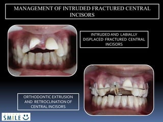 MANAGEMENT OF INTRUDED FRACTURED CENTRAL
INCISORS
INTRUDED AND LABIALLY
DISPLACED FRACTURED CENTRAL
INCISORS
ORTHODONTIC EXTRUSION
AND RETROCLINATIONOF
CENTRAL INCISORS
 