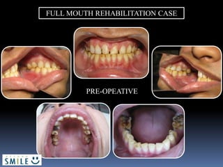 PRE-OPEATIVE
FULL MOUTH REHABILITATION CASE
 
