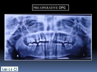PRE-OPERATIVE OPG
 
