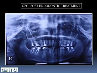 OPG- POST ENDODONTIC TREATMENT
 
