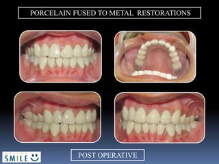PORCELAIN FUSED TO METAL RESTORATIONS
POST OPERATIVE
 