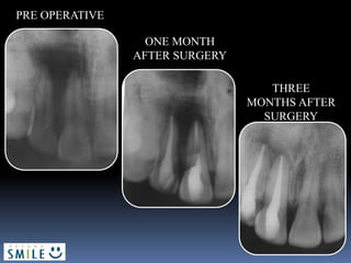PRE OPERATIVE
ONE MONTH
AFTER SURGERY
THREE
MONTHS AFTER
SURGERY
 