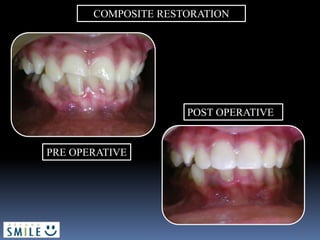 COMPOSITE RESTORATION
PRE OPERATIVE
POST OPERATIVE
 