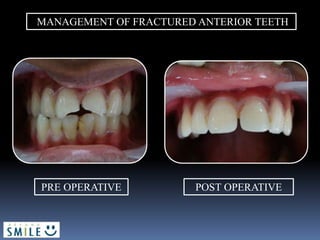 MANAGEMENT OF FRACTURED ANTERIOR TEETH
PRE OPERATIVE POST OPERATIVE
 