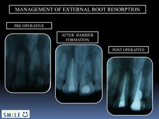 MANAGEMENT OF EXTERNAL ROOT RESORPTION
PRE OPERATIVE
AFTER BARRIER
FORMATION
POST OPERATIVE
 