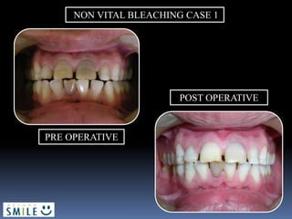 NON VITAL BLEACHING CASE 1
PRE OPERATIVE
POST OPERATIVE
 