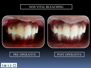 NON VITAL BLEACHING
PRE OPERATIVE POST OPERATIVE
 