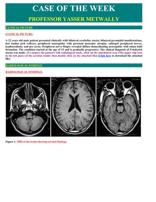 CASE OF THE WEEK
                   PROFESSOR YASSER METWALLY
CLINICAL PICTURE

CLINICAL PICTURE:

A 22 years old male patient presented clinically with bilateral cerebellar ataxia, bilateral pyramidal manifestations,
lost tendon jerk reflexes, peripheral neuropathy with peroneal muscular atrophy, enlarged peripheral nerves,
kyphoscoliosis, and pes cavus. Peripheral nerve biopsy revealed diffuse demyelinating neuropathy with onion bulb
formation. The condition started at the age of 12 and is gradually progressive. The clinical diagnosis of Friedreich
ataxia was made. (To inspect the patient's full radiological study, click on the attachment icon (The paper clip icon
in the left pane) of the acrobat reader then double click on the attached file) (Click here to download the attached
file)

RADIOLOGICAL FINDINGS

RADIOLOGICAL FINDINGS:




Figure 1. MRI of the brain showing normal findings
 