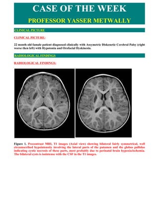 CASE OF THE WEEK
          PROFESSOR YASSER METWALLY
CLINICAL PICTURE

CLINICAL PICTURE:

22 month old famale patient diagnosed clinically with Assymetric Diskenetic Cerebral Palsy (right
worse then left) with Hypotonia and Orofacial Dyskinesia.

RADIOLOGICAL FINDINGS

RADIOLOGICAL FINDINGS:




Figure 1. Precontrast MRI, T1 images (Axial view) showing bilateral fairly symmetrical, well
circumscribed hypointensity involving the lateral parts of the putamen and the globus pallidus
indicating cystic necrosis of these parts, most probably due to perinatal brain hypoxia/ischemia.
The bilateral cysts is isointense with the CSF in the T1 images.
 