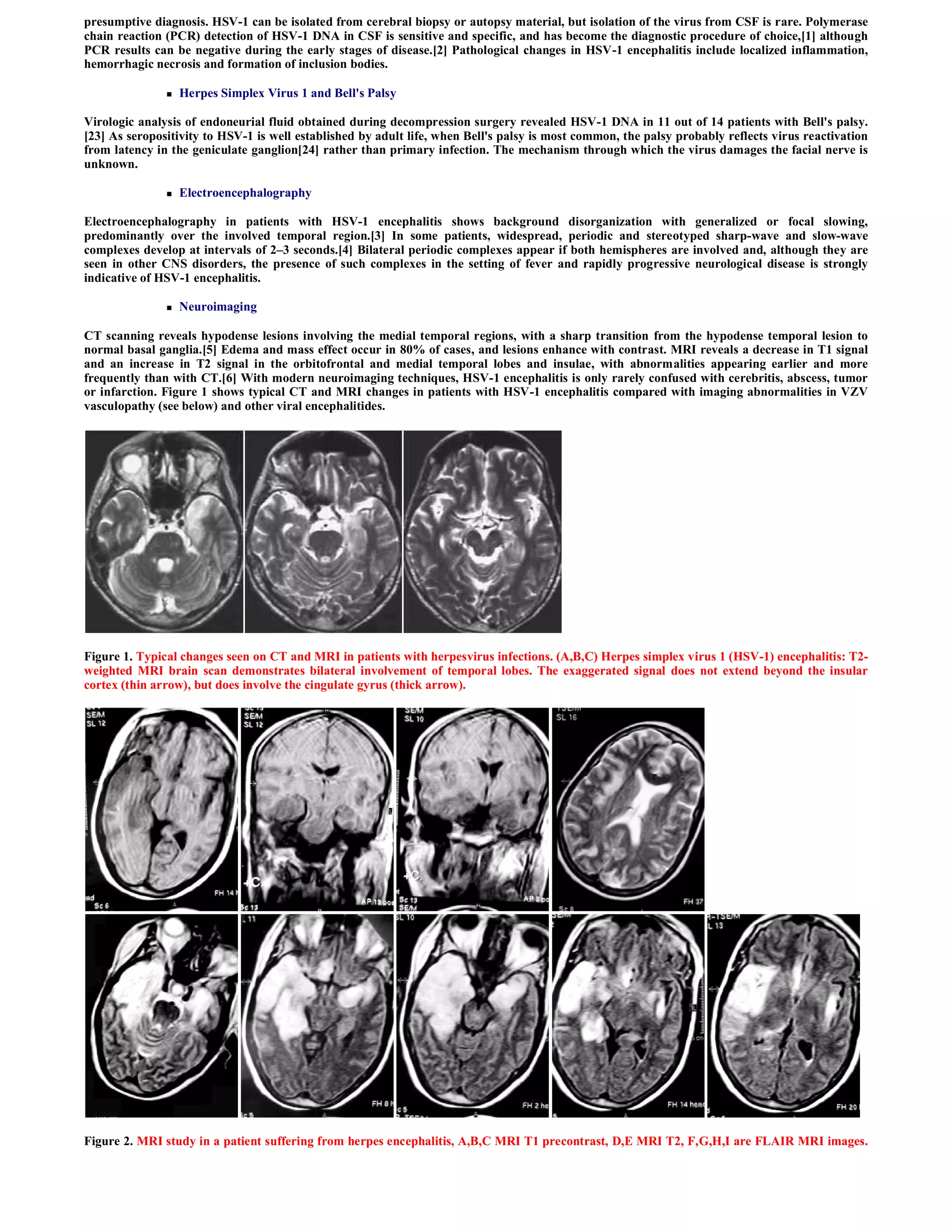 presumptive diagnosis. HSV-1 can be isolated from cerebral biopsy or autopsy material, but isolation of the virus from CSF is rare. Polymerase
chain reaction (PCR) detection of HSV-1 DNA in CSF is sensitive and specific, and has become the diagnostic procedure of choice,[1] although
PCR results can be negative during the early stages of disease.[2] Pathological changes in HSV-1 encephalitis include localized inflammation,
hemorrhagic necrosis and formation of inclusion bodies.

                  Herpes Simplex Virus 1 and Bell's Palsy

Virologic analysis of endoneurial fluid obtained during decompression surgery revealed HSV-1 DNA in 11 out of 14 patients with Bell's palsy.
[23] As seropositivity to HSV-1 is well established by adult life, when Bell's palsy is most common, the palsy probably reflects virus reactivation
from latency in the geniculate ganglion[24] rather than primary infection. The mechanism through which the virus damages the facial nerve is
unknown.

                  Electroencephalography

Electroencephalography in patients with HSV-1 encephalitis shows background disorganization with generalized or focal slowing,
predominantly over the involved temporal region.[3] In some patients, widespread, periodic and stereotyped sharp-wave and slow-wave
complexes develop at intervals of 2–3 seconds.[4] Bilateral periodic complexes appear if both hemispheres are involved and, although they are
seen in other CNS disorders, the presence of such complexes in the setting of fever and rapidly progressive neurological disease is strongly
indicative of HSV-1 encephalitis.

                  Neuroimaging

CT scanning reveals hypodense lesions involving the medial temporal regions, with a sharp transition from the hypodense temporal lesion to
normal basal ganglia.[5] Edema and mass effect occur in 80% of cases, and lesions enhance with contrast. MRI reveals a decrease in T1 signal
and an increase in T2 signal in the orbitofrontal and medial temporal lobes and insulae, with abnormalities appearing earlier and more
frequently than with CT.[6] With modern neuroimaging techniques, HSV-1 encephalitis is only rarely confused with cerebritis, abscess, tumor
or infarction. Figure 1 shows typical CT and MRI changes in patients with HSV-1 encephalitis compared with imaging abnormalities in VZV
vasculopathy (see below) and other viral encephalitides.




Figure 1. Typical changes seen on CT and MRI in patients with herpesvirus infections. (A,B,C) Herpes simplex virus 1 (HSV-1) encephalitis: T2-
weighted MRI brain scan demonstrates bilateral involvement of temporal lobes. The exaggerated signal does not extend beyond the insular
cortex (thin arrow), but does involve the cingulate gyrus (thick arrow).




Figure 2. MRI study in a patient suffering from herpes encephalitis, A,B,C MRI T1 precontrast, D,E MRI T2, F,G,H,I are FLAIR MRI images.
 