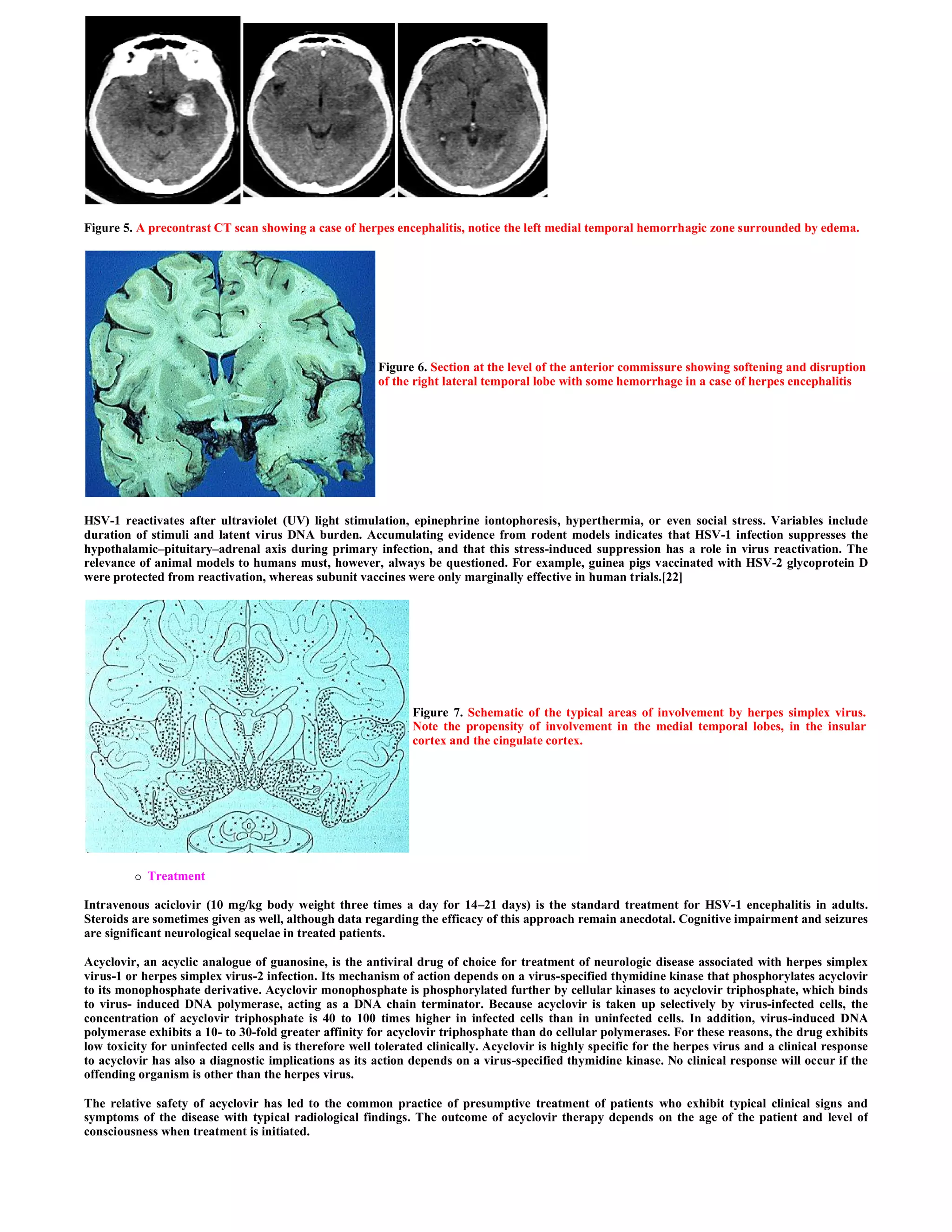 Figure 5. A precontrast CT scan showing a case of herpes encephalitis, notice the left medial temporal hemorrhagic zone surrounded by edema.




                                                        Figure 6. Section at the level of the anterior commissure showing softening and disruption
                                                        of the right lateral temporal lobe with some hemorrhage in a case of herpes encephalitis




HSV-1 reactivates after ultraviolet (UV) light stimulation, epinephrine iontophoresis, hyperthermia, or even social stress. Variables include
duration of stimuli and latent virus DNA burden. Accumulating evidence from rodent models indicates that HSV-1 infection suppresses the
hypothalamic–pituitary–adrenal axis during primary infection, and that this stress-induced suppression has a role in virus reactivation. The
relevance of animal models to humans must, however, always be questioned. For example, guinea pigs vaccinated with HSV-2 glycoprotein D
were protected from reactivation, whereas subunit vaccines were only marginally effective in human trials.[22]




                                                               Figure 7. Schematic of the typical areas of involvement by herpes simplex virus.
                                                               Note the propensity of involvement in the medial temporal lobes, in the insular
                                                               cortex and the cingulate cortex.




            Treatment

Intravenous aciclovir (10 mg/kg body weight three times a day for 14–21 days) is the standard treatment for HSV-1 encephalitis in adults.
Steroids are sometimes given as well, although data regarding the efficacy of this approach remain anecdotal. Cognitive impairment and seizures
are significant neurological sequelae in treated patients.

Acyclovir, an acyclic analogue of guanosine, is the antiviral drug of choice for treatment of neurologic disease associated with herpes simplex
virus-1 or herpes simplex virus-2 infection. Its mechanism of action depends on a virus-specified thymidine kinase that phosphorylates acyclovir
to its monophosphate derivative. Acyclovir monophosphate is phosphorylated further by cellular kinases to acyclovir triphosphate, which binds
to virus- induced DNA polymerase, acting as a DNA chain terminator. Because acyclovir is taken up selectively by virus-infected cells, the
concentration of acyclovir triphosphate is 40 to 100 times higher in infected cells than in uninfected cells. In addition, virus-induced DNA
polymerase exhibits a 10- to 30-fold greater affinity for acyclovir triphosphate than do cellular polymerases. For these reasons, the drug exhibits
low toxicity for uninfected cells and is therefore well tolerated clinically. Acyclovir is highly specific for the herpes virus and a clinical response
to acyclovir has also a diagnostic implications as its action depends on a virus-specified thymidine kinase. No clinical response will occur if the
offending organism is other than the herpes virus.

The relative safety of acyclovir has led to the common practice of presumptive treatment of patients who exhibit typical clinical signs and
symptoms of the disease with typical radiological findings. The outcome of acyclovir therapy depends on the age of the patient and level of
consciousness when treatment is initiated.
 