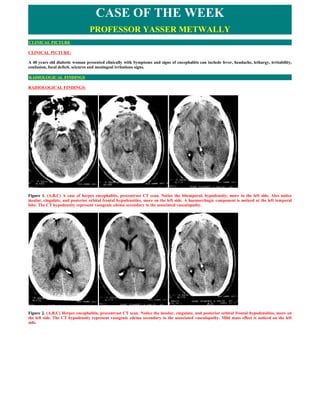CASE OF THE WEEK
                                 PROFESSOR YASSER METWALLY
CLINICAL PICTURE

CLINICAL PICTURE:

A 40 years old diabetic woman presented clinically with Symptoms and signs of encephalitis can include fever, headache, lethargy, irritability,
confusion, focal deficit, seizures and meningeal irritations signs.

RADIOLOGICAL FINDINGS

RADIOLOGICAL FINDINGS:




Figure 1. (A,B,C) A case of herpes encephalitis, precontrast CT scan. Notice the bitemporal, hypodensity, more in the left side. Also notice
insular, cingulate, and posterior orbital frontal hypodensities, more on the left side. A haemorrhagic component is noticed at the left temporal
lobe. The CT hypodensity represent vasogenic edema secondary to the associated vasculopathy.




Figure 2. (A,B,C) Herpes encephalitis, precontrast CT scan. Notice the insular, cingulate, and posterior orbital frontal hypodensities, more on
the left side. The CT hypodensity represent vasogenic edema secondary to the associated vasculopathy. Mild mass effect is noticed on the left
side.
 