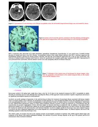 Figure 5. A precontrast CT scan showing a case of herpes encephalitis, notice the left medial temporal hemorrhagic zone surrounded by edema.




                                                        Figure 6. Section at the level of the anterior commissure showing softening and disruption
                                                        of the right lateral temporal lobe with some hemorrhage in a case of herpes encephalitis




HSV-1 reactivates after ultraviolet (UV) light stimulation, epinephrine iontophoresis, hyperthermia, or even social stress. Variables include
duration of stimuli and latent virus DNA burden. Accumulating evidence from rodent models indicates that HSV-1 infection suppresses the
hypothalamic–pituitary–adrenal axis during primary infection, and that this stress-induced suppression has a role in virus reactivation. The
relevance of animal models to humans must, however, always be questioned. For example, guinea pigs vaccinated with HSV-2 glycoprotein D
were protected from reactivation, whereas subunit vaccines were only marginally effective in human trials.[22]




                                                               Figure 7. Schematic of the typical areas of involvement by herpes simplex virus.
                                                               Note the propensity of involvement in the medial temporal lobes, in the insular
                                                               cortex and the cingulate cortex.




            Treatment

Intravenous aciclovir (10 mg/kg body weight three times a day for 14–21 days) is the standard treatment for HSV-1 encephalitis in adults.
Steroids are sometimes given as well, although data regarding the efficacy of this approach remain anecdotal. Cognitive impairment and seizures
are significant neurological sequelae in treated patients.

Acyclovir, an acyclic analogue of guanosine, is the antiviral drug of choice for treatment of neurologic disease associated with herpes simplex
virus-1 or herpes simplex virus-2 infection. Its mechanism of action depends on a virus-specified thymidine kinase that phosphorylates acyclovir
to its monophosphate derivative. Acyclovir monophosphate is phosphorylated further by cellular kinases to acyclovir triphosphate, which binds
to virus- induced DNA polymerase, acting as a DNA chain terminator. Because acyclovir is taken up selectively by virus-infected cells, the
concentration of acyclovir triphosphate is 40 to 100 times higher in infected cells than in uninfected cells. In addition, virus-induced DNA
polymerase exhibits a 10- to 30-fold greater affinity for acyclovir triphosphate than do cellular polymerases. For these reasons, the drug exhibits
low toxicity for uninfected cells and is therefore well tolerated clinically. Acyclovir is highly specific for the herpes virus and a clinical response
to acyclovir has also a diagnostic implications as its action depends on a virus-specified thymidine kinase. No clinical response will occur if the
offending organism is other than the herpes virus.

The relative safety of acyclovir has led to the common practice of presumptive treatment of patients who exhibit typical clinical signs and
symptoms of the disease with typical radiological findings. The outcome of acyclovir therapy depends on the age of the patient and level of
consciousness when treatment is initiated.
 