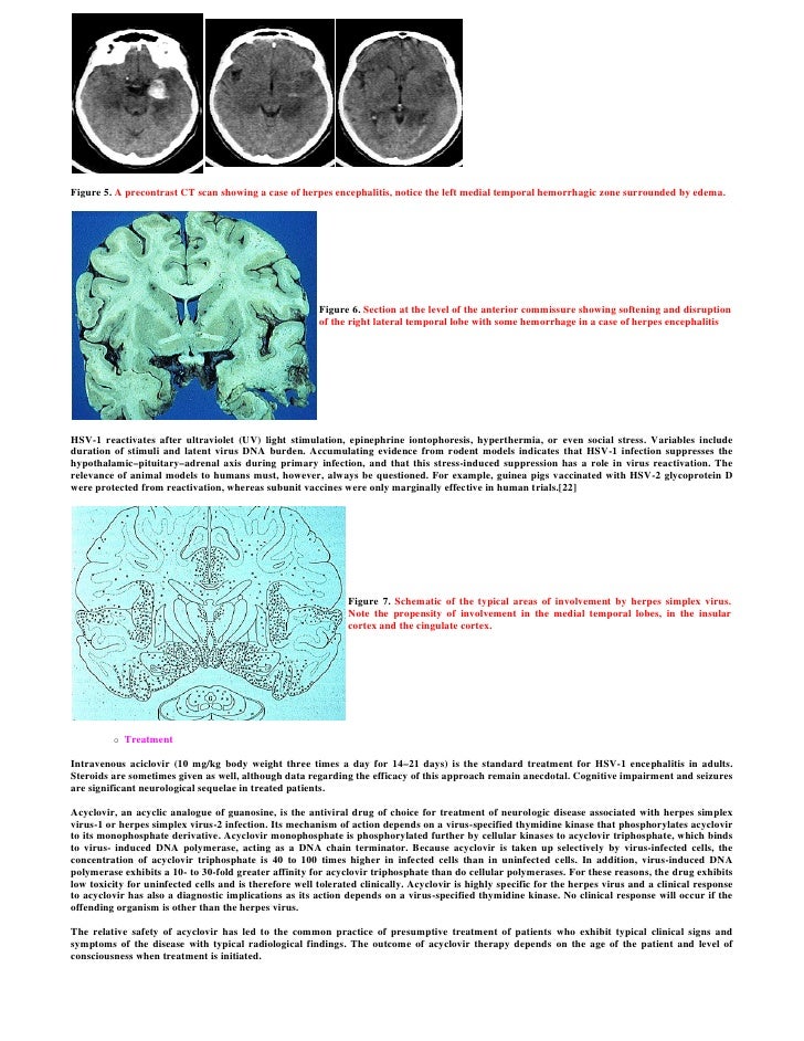 an essay on rasmussens encephalitis Read t-cell subsets and interleukin-6 response in rasmussen’s encephalitis, pediatric neurology on deepdyve, the largest online rental service for scholarly. an essay on rasmussens encephalitis Read t-cell subsets and interleukin-6 response in rasmussen’s encephalitis, pediatric neurology on deepdyve, the largest online rental service for scholarly.