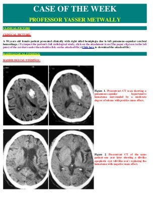 CLINICAL PICTURE:
A 50 years old female patient presented clinically with right sided hemiplegia due to left putameno-capsular cerebral
hemorrhage. (To inspect the patient's full radiological study, click on the attachment icon (The paper clip icon in the left
pane) of the acrobat reader then double click on the attached file) (Click here to download the attached file)
RADIOLOGICAL FINDINGS:
CASE OF THE WEEK
PROFESSOR YASSER METWALLY
CLINICAL PICTURE
RADIOLOGICAL FINDINGS
Figure 1. Precontrast CT scan showing a
putameno-capsular hypertensive
hematoma surrounded by a moderate
degree of edema with positive mass effect.
Figure 2. Precontrast CT of the same
patient one year later showing a slit-like
apoplectic cyst (slit-like scar) replacing the
hematoma with negative mass effect.
 