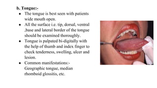 b. Tongue:-
● The tongue is best seen with patients
wide mouth open.
● All the surface i.e. tip, dorsal, ventral
,base and lateral border of the tongue
should be examined thoroughly.
● Tongue is palpated bi-digitally with
the help of thumb and index finger to
check tenderness, swelling, ulcer and
lesion.
● Common manifestations:-
Geographic tongue, median
rhomboid glossitis, etc.
 