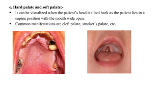e. Hard palate and soft palate:-
 It can be visualized when the patient’s head is tilted back as the patient lies in a
supine position with the mouth wide open.
 Common manifestations are cleft palate, smoker’s palate, etc.
 