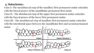 g. Malocclusion:-
Class I:-The mesiobuccal cusp of the maxillary first permanent molar coincides
with the buccal groove of the mandibular permanent first molar.
Class II:- The distobuccal cusp of the upper first permanent molar coincides
with the buccal groove of the lower first permanent molar.
Class III:- The mesiobuccal cusp of maxillary first permanent molar coincides
with the interdental space between the mandibular first and second permanent
molar.
 