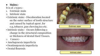 ● Stains:-
It is of 2 types:-
1. Extrinsic stain
2. Intrinsic stain
• Extrinsic stain:- Discoloration located
on the outer surface of tooth structure
and caused by topical agent .for
e.g,.tobacco ,pan chewing,tea etc.
• Intrinsic stain:- Occurs following a
change in the structural composition
or thickness of dental Hard Tissues.
o Causes:-
• Amelogenesis imperfecta
• Dentinogenesis imperfecta
• Dental flourosis
Extrinsic stain
Intrinsic stain
 
