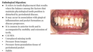 Pathological Migration:
● It refers to tooth displacement that results
when the balance among the factors that
maintain physiological tooth position is
disturbed by periodontal disease.
● It may accur in asoociation with gingival
inflammation and pocket formation as
disease progresses.
● It is cmmon in anterior teeth and is
accompanied by mobility and extrusion of
teeth.
● CAUSES:
• Unreplaced missing teeth
• Pressure from tongue
• Pressure form granulation tissue of
periodontal pocket
• Habits
 
