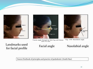 Landmarks used
for facial profile
Facial angle Nasolabial angle
32
Source:Textbook of principles and practice of pedodontic (Arathi Rao)
 