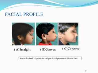 FACIAL PROFILE
33
( A)Straight ( B)Convex ( C)Concave
Source:Textbook of principles and practice of pedodontic (Arathi Rao)
 