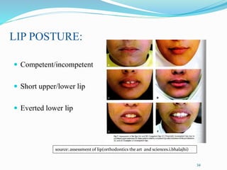LIP POSTURE:
34
34
 Competent/incompetent
 Short upper/lower lip
 Everted lower lip
source: assessment of lip(orthodontics the art and sciences.i.bhalajhi)
 