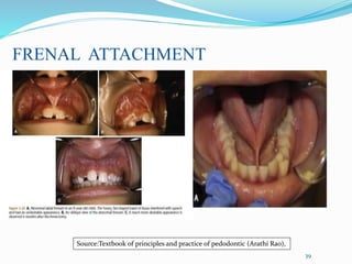 39
FRENAL ATTACHMENT
Source:Textbook of principles and practice of pedodontic (Arathi Rao),
 