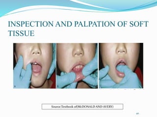 INSPECTION AND PALPATION OF SOFT
TISSUE
40
Source:Textbook of(McDONALD AND AVERY)
 