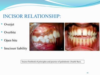 45
INCISOR RELATIONSHIP:
• Overjet
• Overbite
• Open bite
• Inscissor liability
Source:Textbook of principles and practice of pedodontic (Arathi Rao),
 