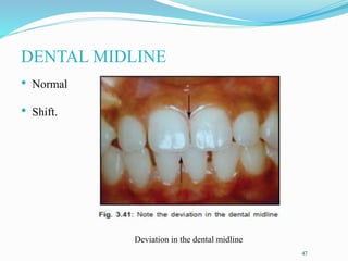 47
DENTAL MIDLINE
• Normal
• Shift.
Deviation in the dental midline
 