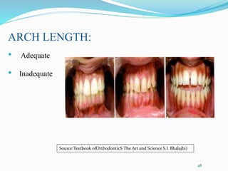ARCH LENGTH:
• Adequate
• Inadequate
48
Source:Textbook ofOrthodonticS The Art and Science S.I. Bhalajhi)
 